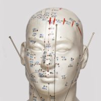 acupuncture melbourne
