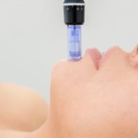 microneedling